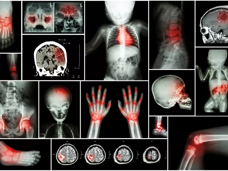 Udar mózgu – powtórny atak