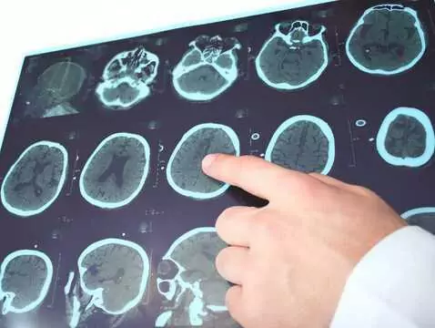 Prace nad nową metodą leczenia choroby Parkinsona i alternatywną drogą podawania leków