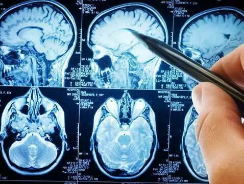 Jakie mogą być wczesne objawy guza mózgu?