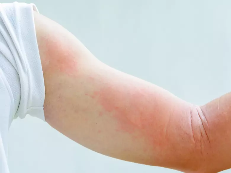 Neuralgia półpaścowa – co to takiego?